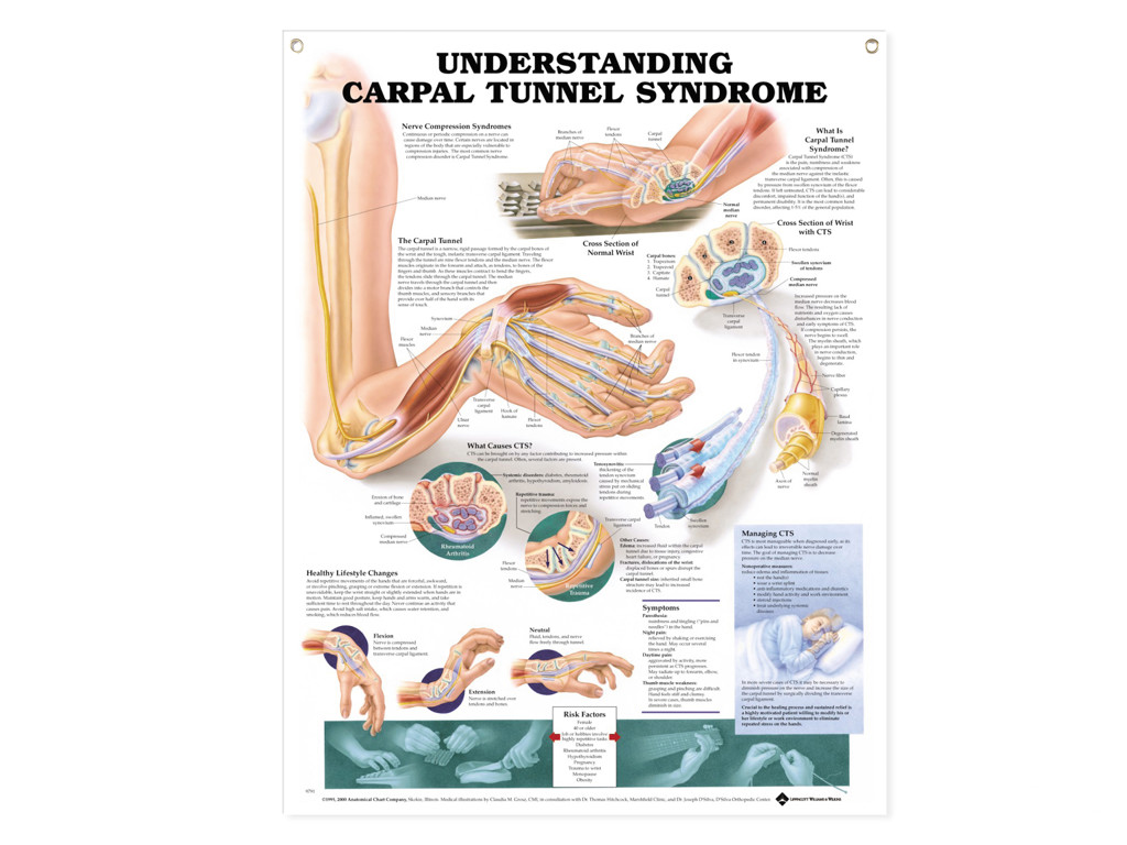 Carpal Tunnel Syndrome Wall Chart