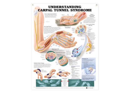 Carpal Tunnel Syndrome Wall Chart