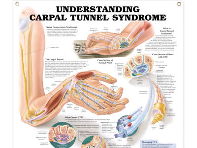 Carpal Tunnel Syndrome Wall Chart