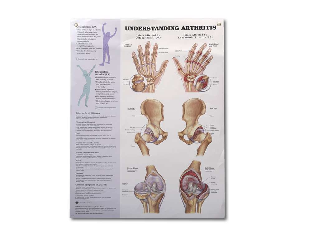 Arthritis/Joint Wall Chart