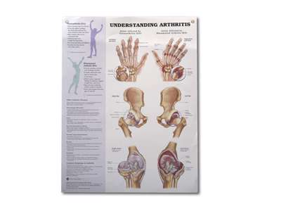Arthritis/Joint Wall Chart