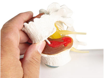 Stadier af diskusdegeneration anatomisk model
