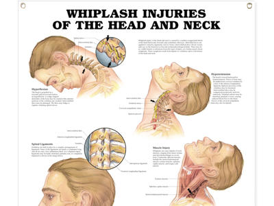 Whiplash, Head/Neck Injuries Wall Chart