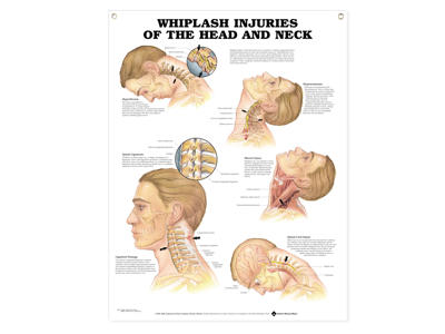 Whiplash, Head/Neck Injuries Wall Chart